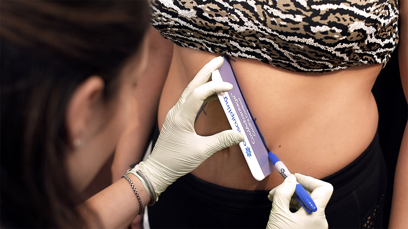CoolSculpting Treatment Photography Photo #10
