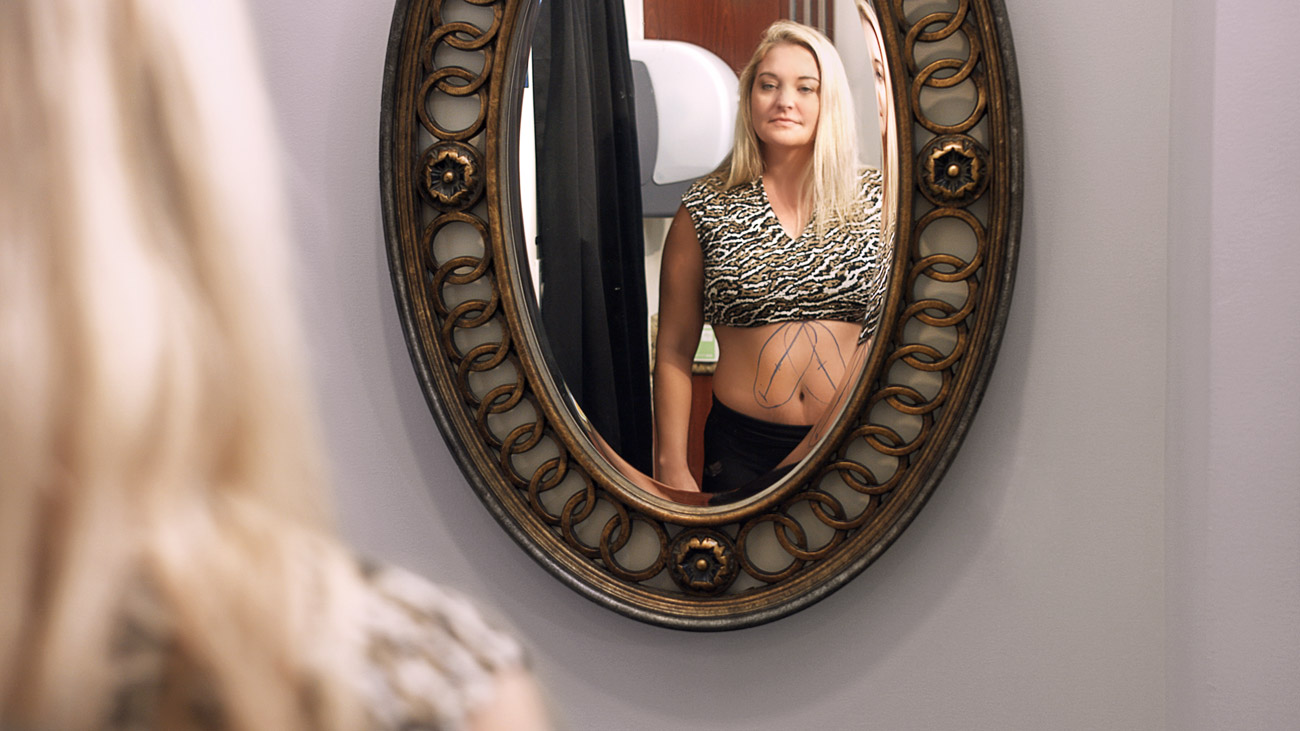 CoolSculpting Treatment Photography Photo #14