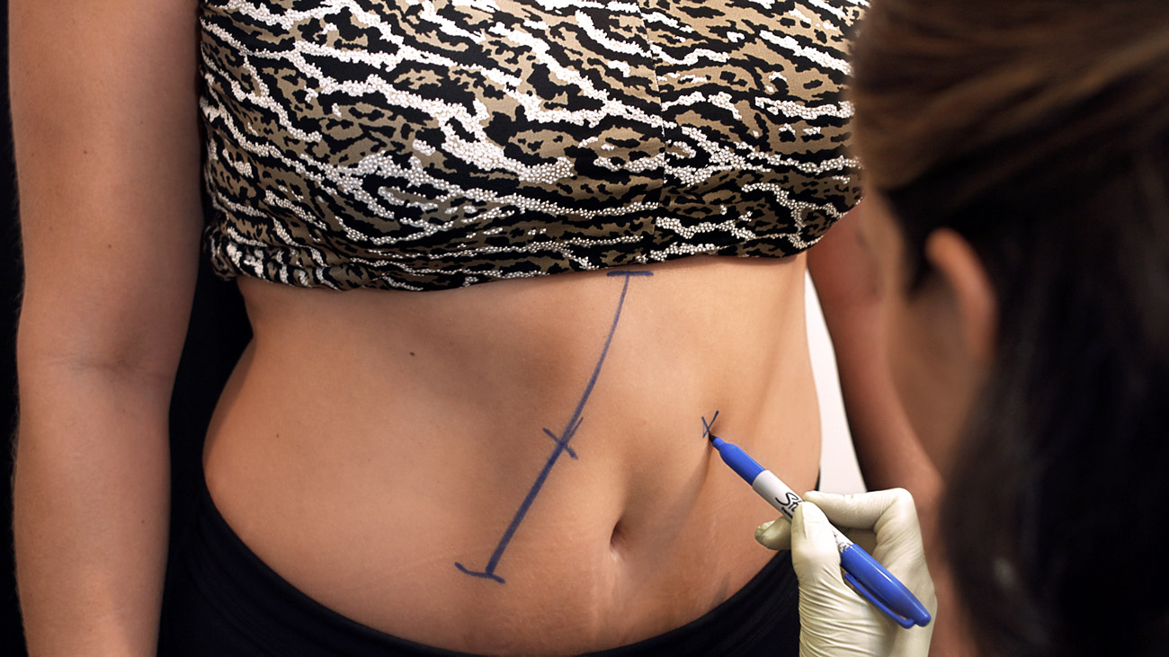 CoolSculpting Treatment Photography Photo #9