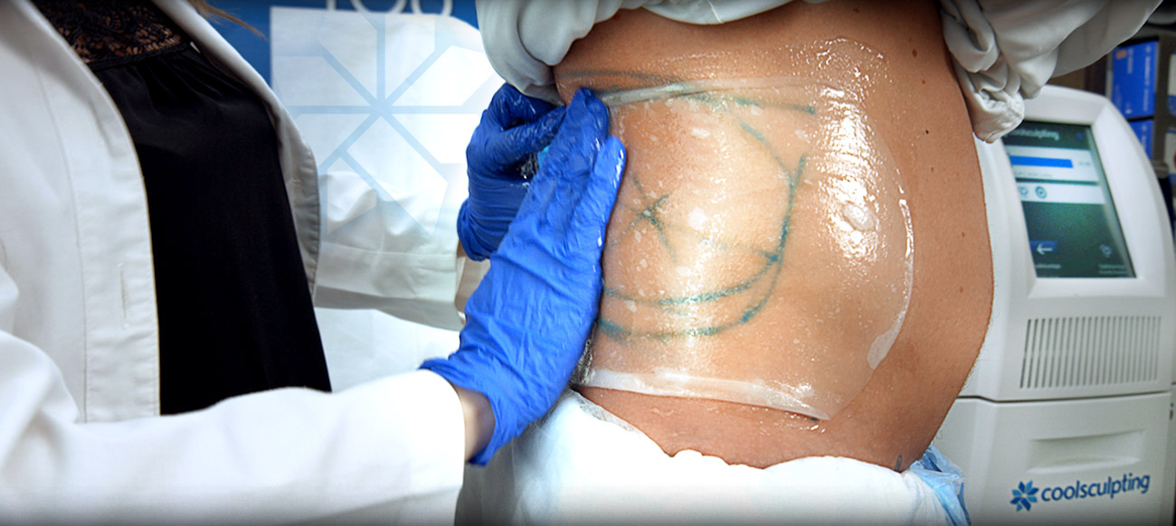 CoolSculpting Treatment Photography for Bowes Dermatology by Riverchase in Miami. Photo #1.
