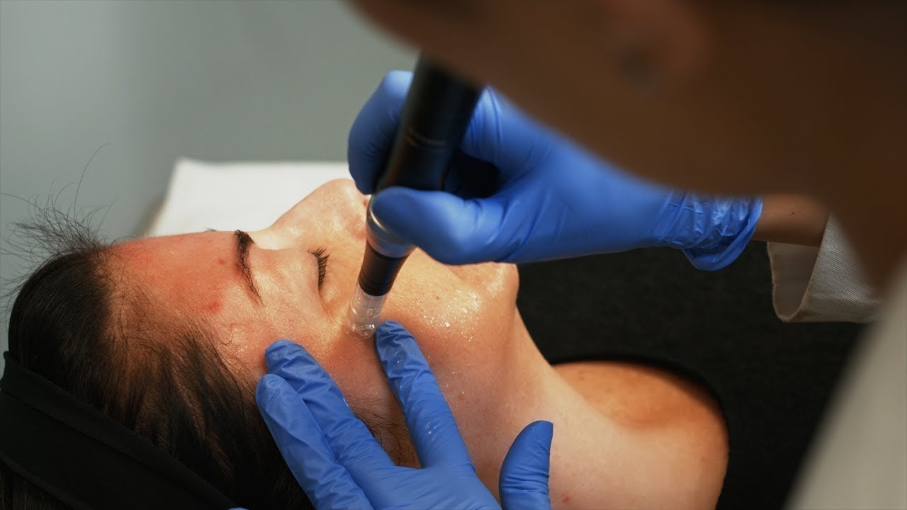 Microneedling treatment educational video production. Customer: Natalie Suarez, PA-C, at Sunset Dermatology in South Miami.